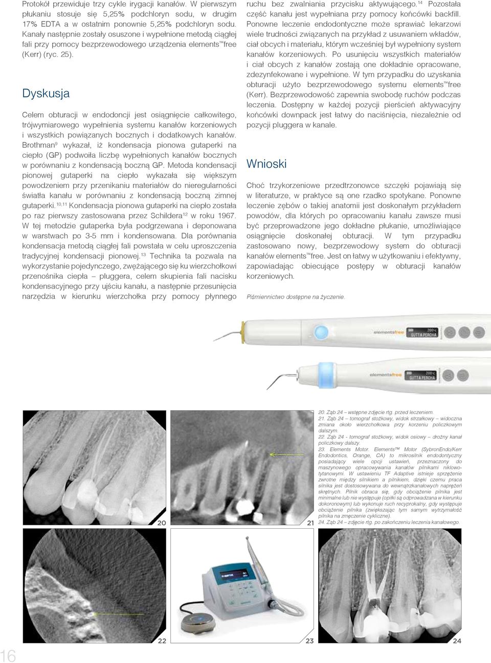 Dyskusja Celem obturacji w endodoncji jest osiągnięcie całkowitego, trójwymiarowego wypełnienia systemu kanałów korzeniowych i wszystkich powiązanych bocznych i dodatkowych kanałów.