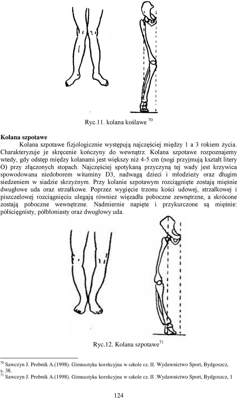 Najczęściej spotykaną przyczyną tej wady jest krzywica spowodowana niedoborem witaminy D3, nadwagą dzieci i młodzieży oraz długim siedzeniem w siadzie skrzyżnym.