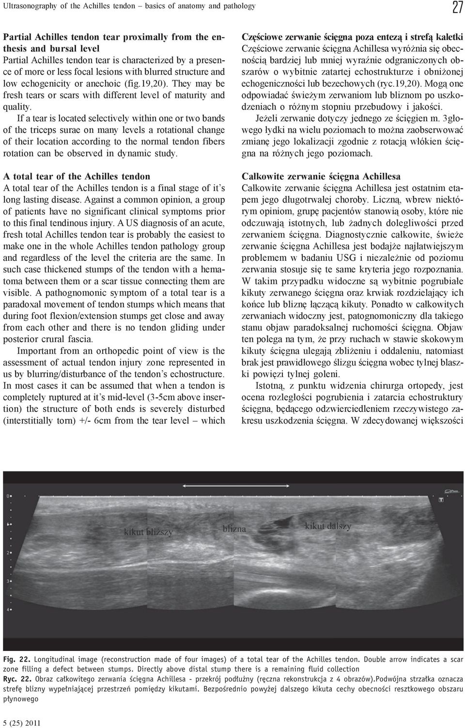 If a tear is located selectively within one or two bands of the triceps surae on many levels a rotational change of their location according to the normal tendon fibers rotation can be observed in