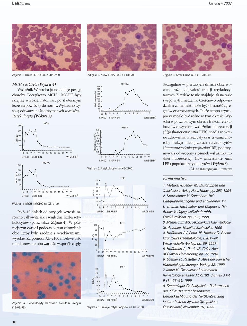 MCH i MCHC na XE-2100 Po 8 10 dniach od przyj cia wzros a zarówno ca kowita jak i wzgl dna liczba retykulocytów (patrz tak e Zdj cie 4).