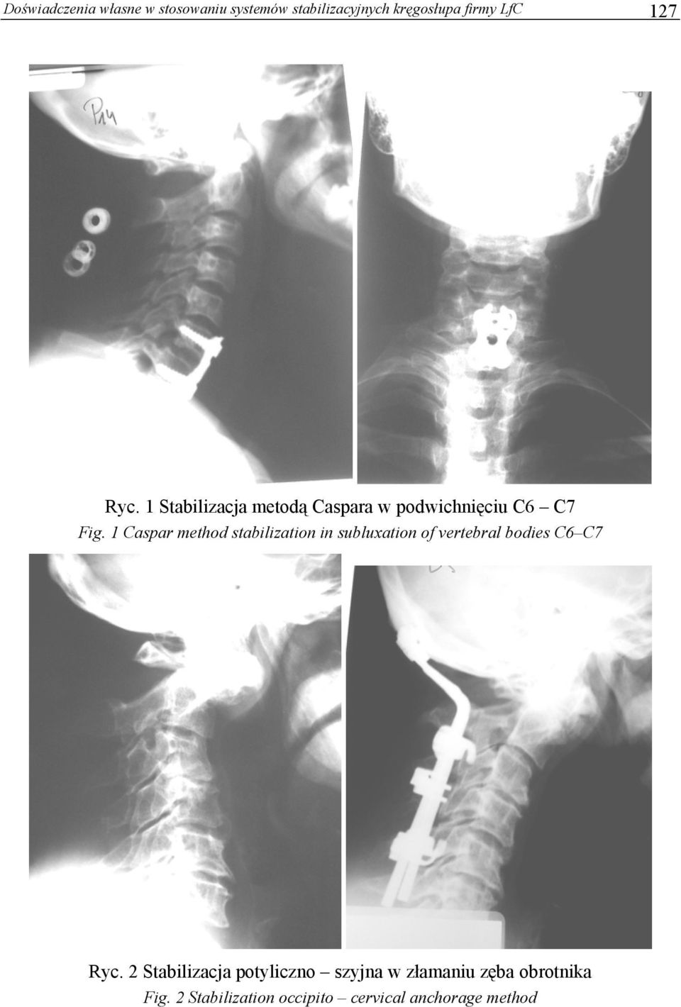 1 Caspar method stabilization in subluxation of vertebral bodies C6 C7 Ryc.