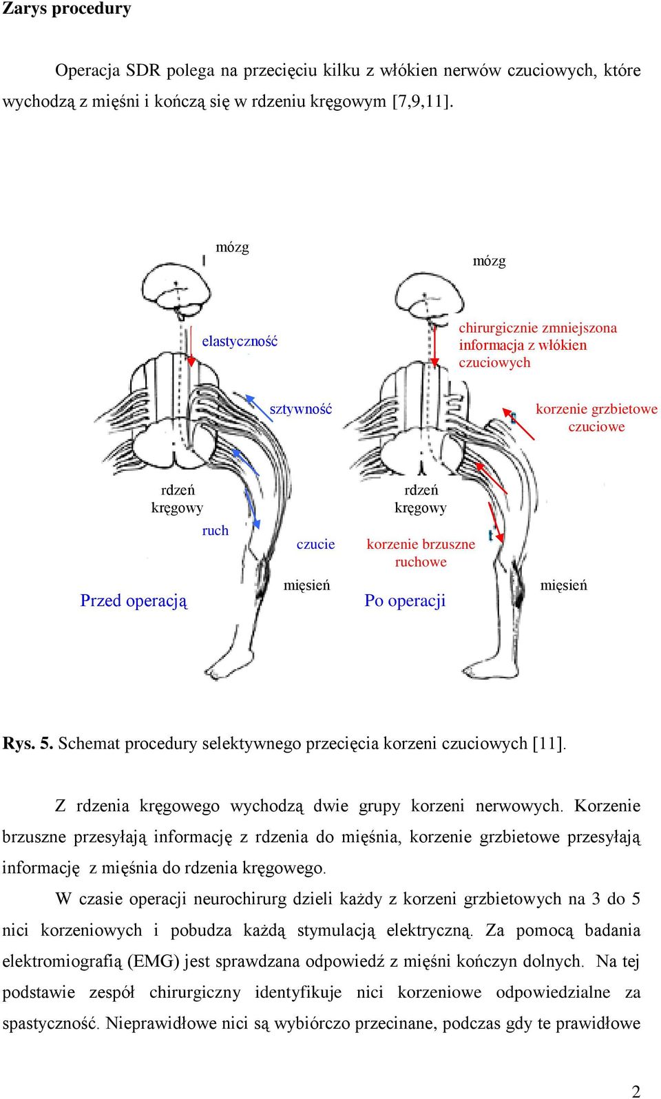 operacją mięsień Po operacji mięsień Rys. 5. Schemat procedury selektywnego przecięcia korzeni czuciowych [11]. Z rdzenia kręgowego wychodzą dwie grupy korzeni nerwowych.