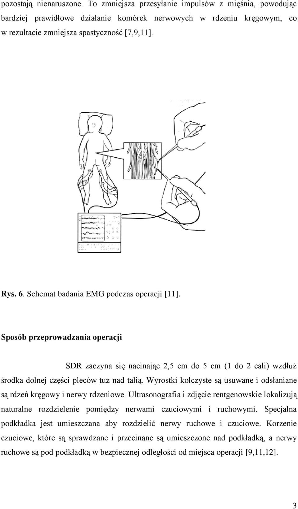 Wyrostki kolczyste są usuwane i odsłaniane są rdzeń kręgowy i nerwy rdzeniowe. Ultrasonografia i zdjęcie rentgenowskie lokalizują naturalne rozdzielenie pomiędzy nerwami czuciowymi i ruchowymi.