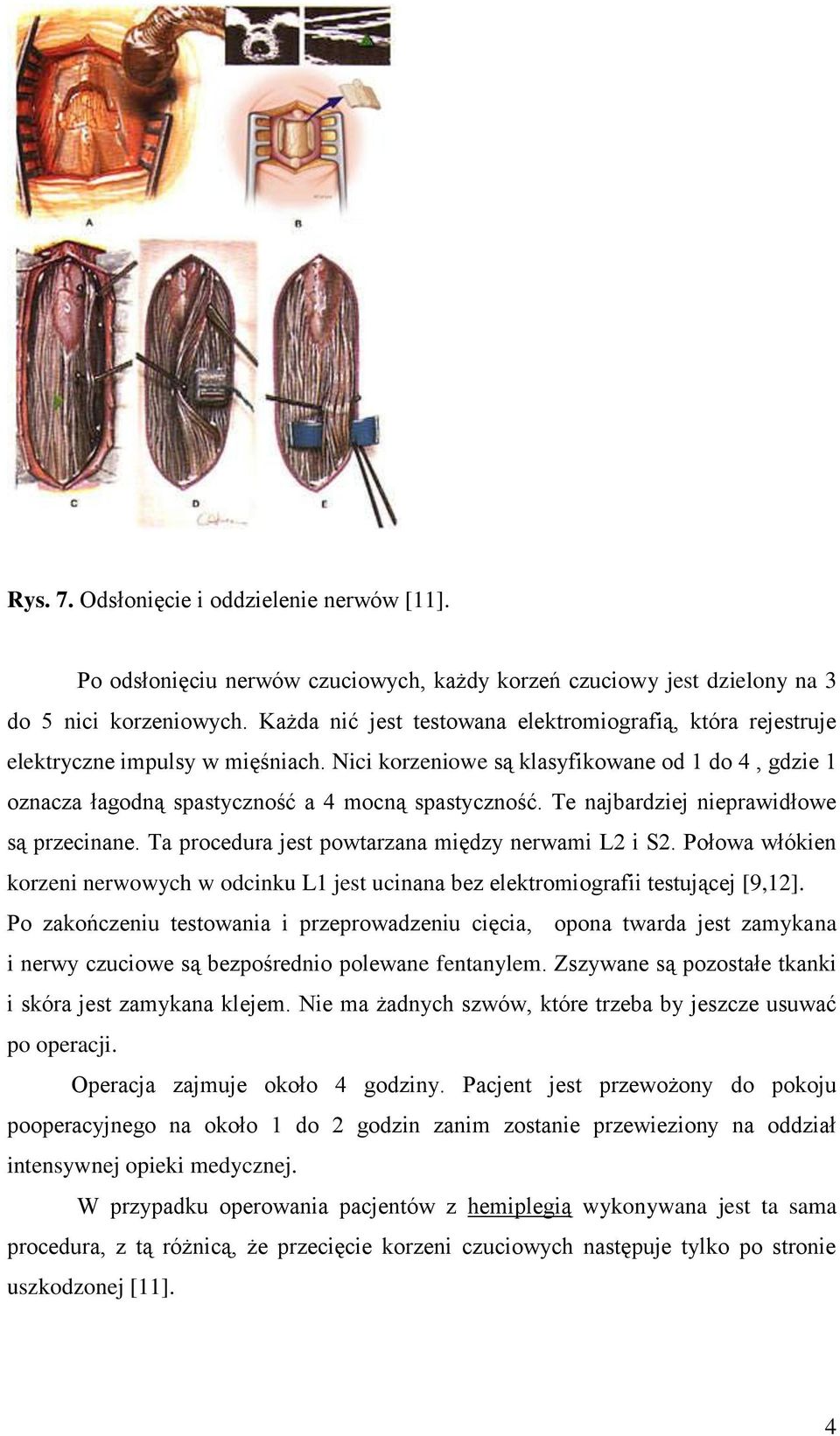 Te najbardziej nieprawidłowe są przecinane. Ta procedura jest powtarzana między nerwami L2 i S2. Połowa włókien korzeni nerwowych w odcinku L1 jest ucinana bez elektromiografii testującej [9,12].