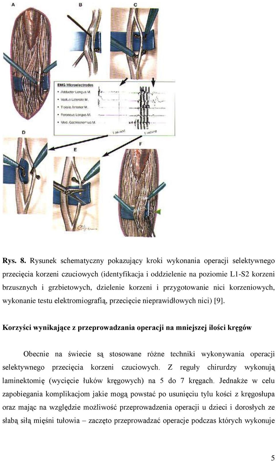 i przygotowanie nici korzeniowych, wykonanie testu elektromiografią, przecięcie nieprawidłowych nici) [9].