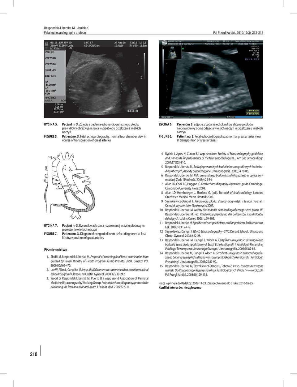 FIGURE 7. Piśmiennictwo Pacjent nr 3. Rysunek wady serca rozpoznanej w życiu płodowym: przełożenie wielkich naczyń Patient no. 3. Diagram of congenital heart defect diagnosed at fetal life: transposition of great arteries 1.