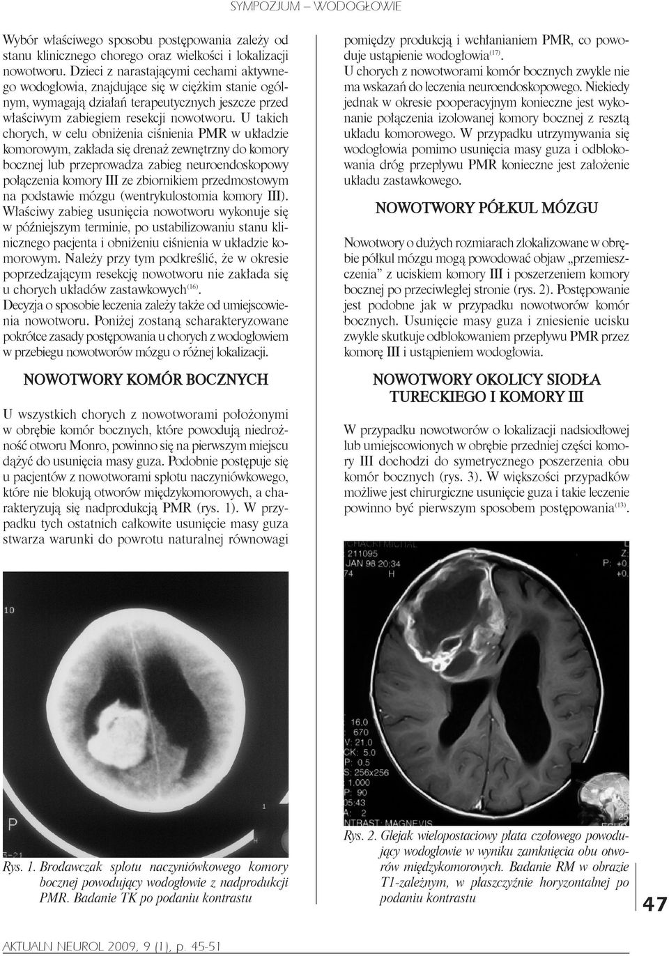 U takich chorych, w celu obniżenia ciśnienia PMR w układzie komorowym, zakłada się drenaż zewnętrzny do komory bocznej lub przeprowadza zabieg neuroendoskopowy połączenia komory III ze zbiornikiem