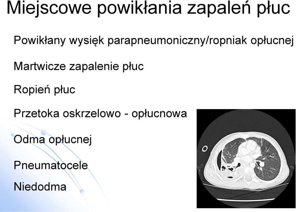 Martwicze zapalenie płuc Ropień płuc Przetoka