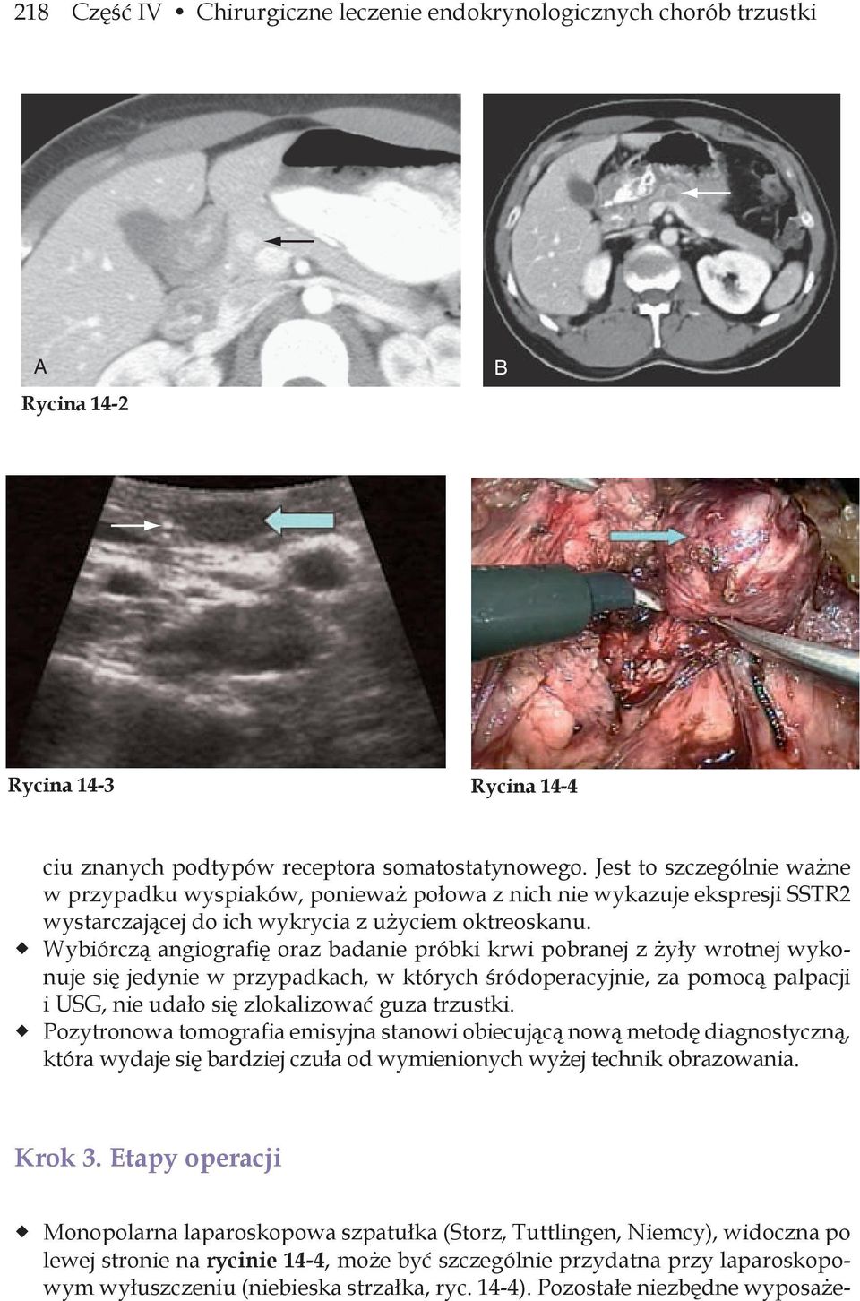 Wybiórczą angiografię oraz badanie próbki krwi pobranej z żyły wrotnej wykonuje się jedynie w przypadkach, w których śródoperacyjnie, za pomocą palpacji i USG, nie udało się zlokalizować guza