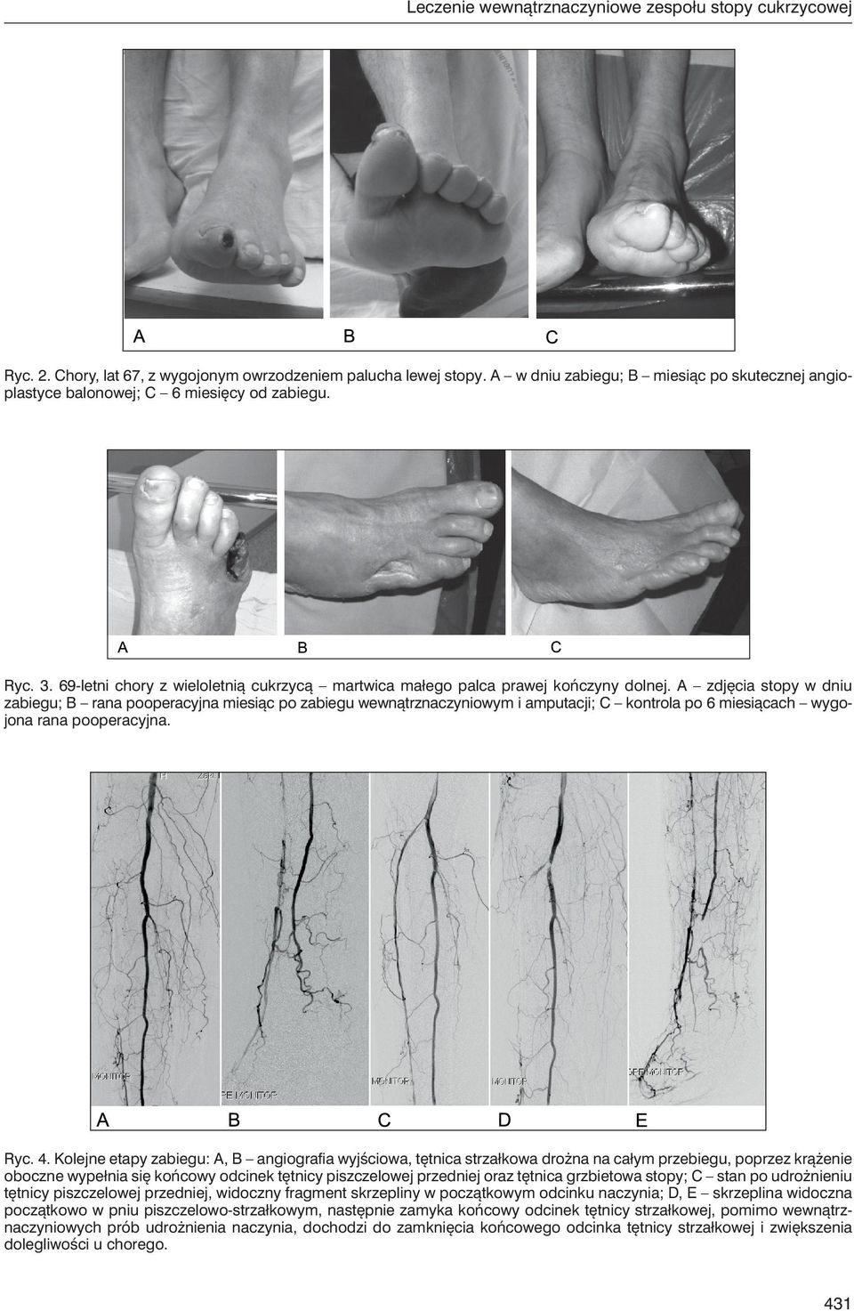 A zdjęcia stopy w dniu zabiegu; B rana pooperacyjna miesiąc po zabiegu wewnątrznaczyniowym i amputacji; C kontrola po 6 miesiącach wygojona rana pooperacyjna. Ryc. 4.