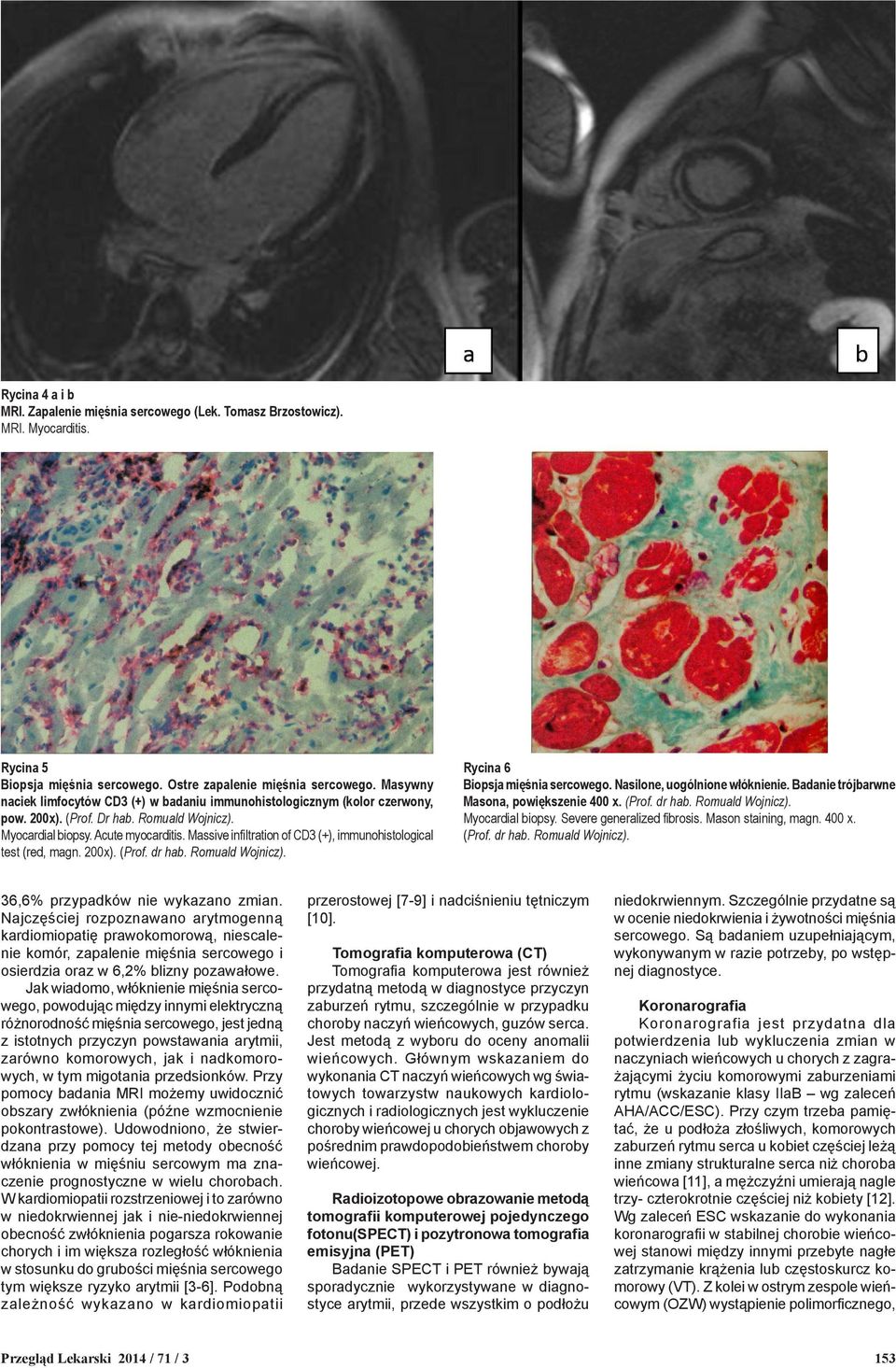 Massive infiltration of CD3 (+), immunohistological test (red, magn. 200x). (Prof. dr hab. Romuald Wojnicz). Rycina 6 Biopsja mięśnia sercowego. Nasilone, uogólnione włóknienie.