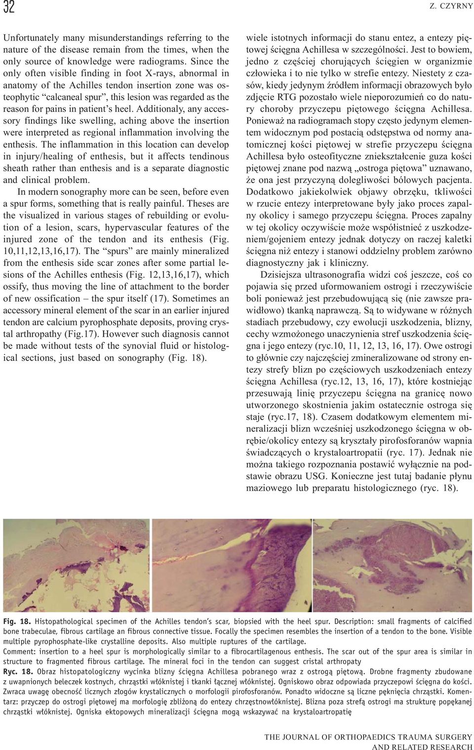 patient s heel. Additionaly, any accessory findings like swelling, aching above the insertion were interpreted as regional inflammation involving the enthesis.