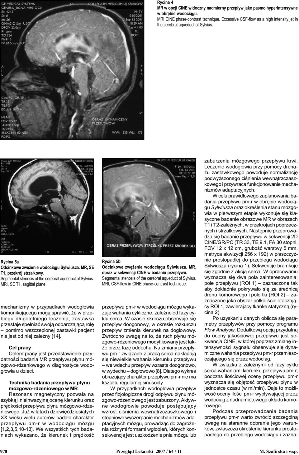 Segmental stenosis of the cerebral aqueduct of Sylvius. MRI, SE T1, sagittal plane. Rycina 5b Odcinkowe zwê enie wodoci¹gu Sylwiusza. MR, obraz w sekwencji CINE w badaniu przep³ywu.