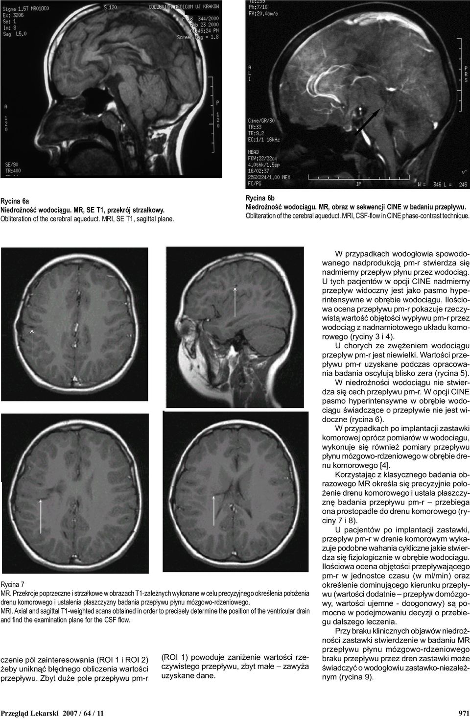Przekroje poprzeczne i strza³kowe w obrazach T1-zale nych wykonane w celu precyzyjnego okre lenia po³o enia drenu komorowego i ustalenia p³aszczyzny badania przep³ywu p³ynu mózgowo-rdzeniowego. MRI.