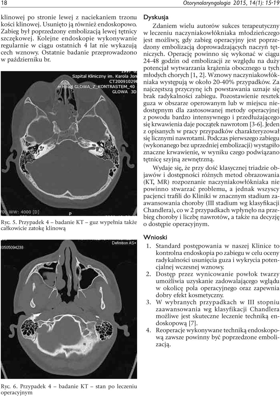 Przypadek 4 badanie KT guz wypełnia także całkowicie zatokę klinową Dyskusja Zdaniem wielu autorów sukces terapeutyczny w leczeniu naczyniakowłókniaka młodzieńczego jest możliwy, gdy zabieg