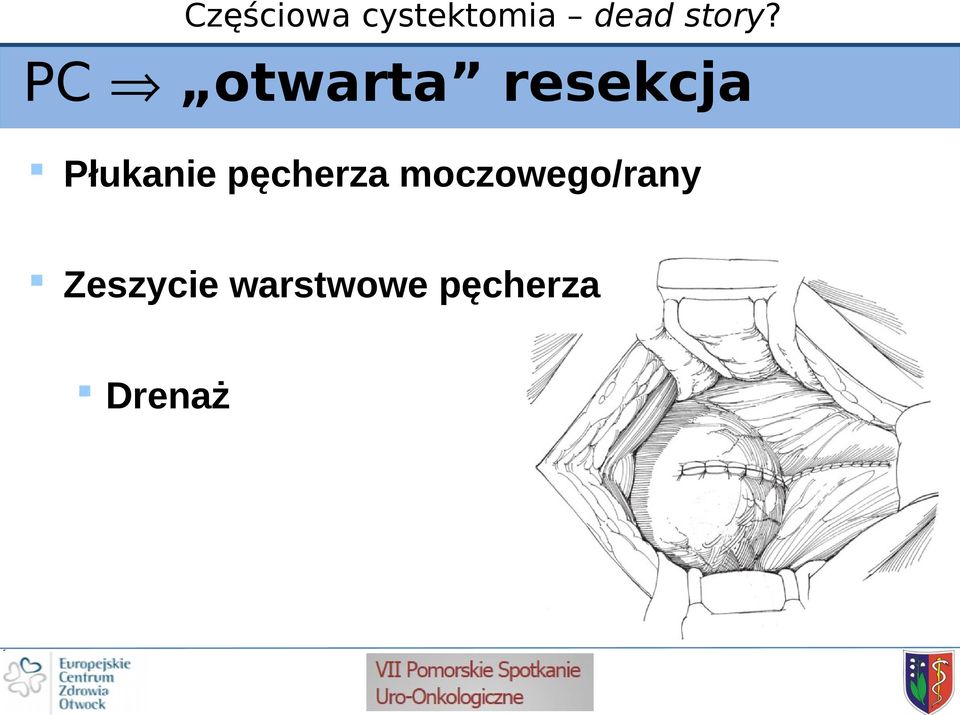 moczowego/rany