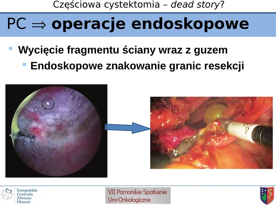 wraz z guzem Endoskopowe