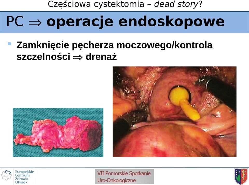 Zamknięcie pęcherza