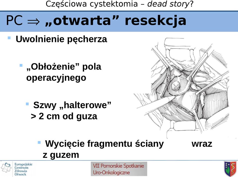 operacyjnego Szwy halterowe > 2