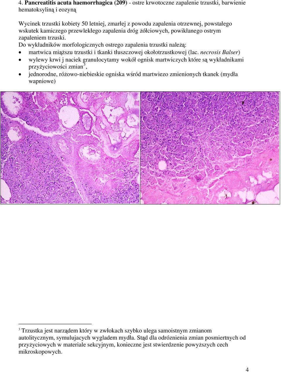Do wykładników morfologicznych ostrego zapalenia trzustki należą: martwica miąższu trzustki i tkanki tłuszczowej okołotrzustkowej (lac.