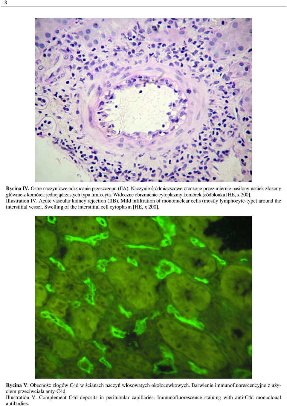 Mild infiltration of mononuclear cells (mostly lymphocyte-type) around the interstitial vessel. Swelling of the interstitial cell cytoplasm [HE, x 200]. Rycina V.