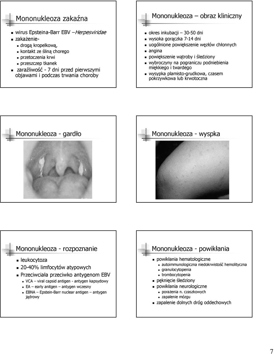 pograniczu podniebienia miękkiego i twardego wysypka plamisto-grudkowa, czasem pokrzywkowa lub krwotoczna Mononukleoza - gardło Mononukleoza - wyspka Mononukleoza - rozpoznanie leukocytoza 20-40%