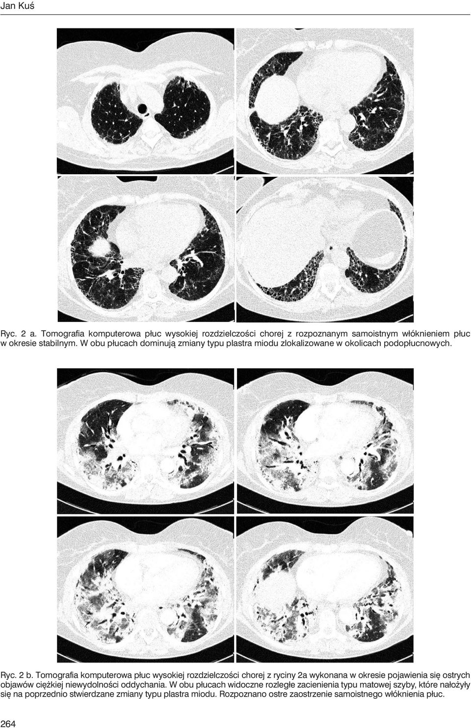 Tomografia komputerowa płuc wysokiej rozdzielczości chorej z ryciny 2a wykonana w okresie pojawienia się ostrych objawów ciężkiej niewydolności