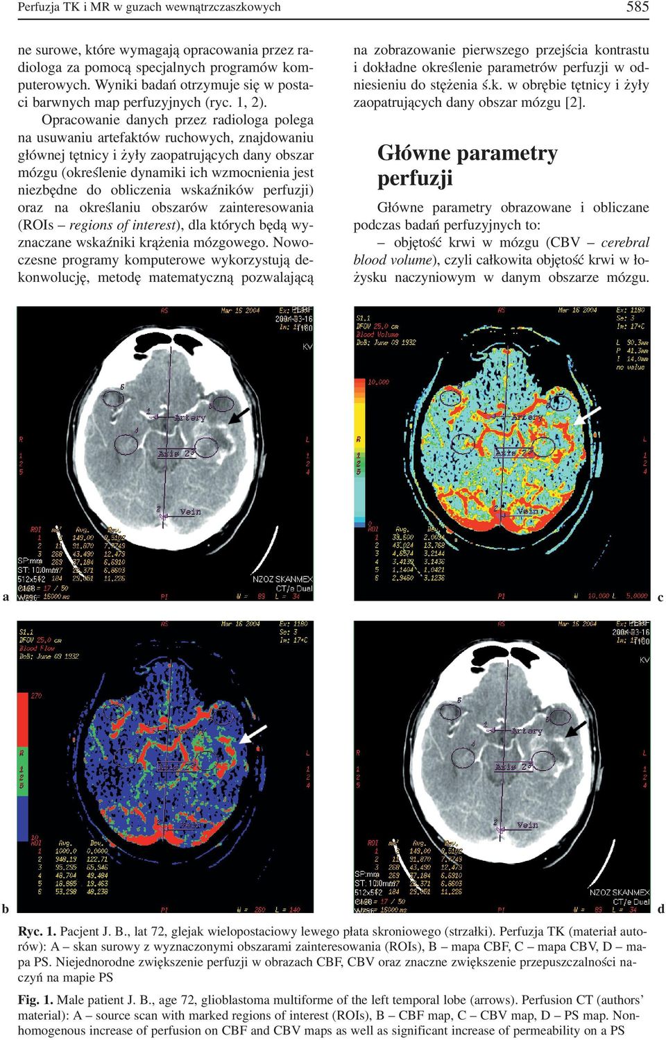 Opracowanie danych przez radiologa polega na usuwaniu artefaktów ruchowych, znajdowaniu głównej tętnicy i żyły zaopatrujących dany obszar mózgu (określenie dynamiki ich wzmocnienia jest niezbędne do
