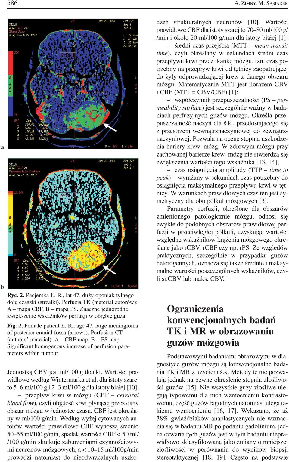 Perfusion CT (authors material): A CBF map, B PS map. Significant homogenous increase of perfusion para meters within tumour Jednostką CBV jest ml/100 g tkanki.
