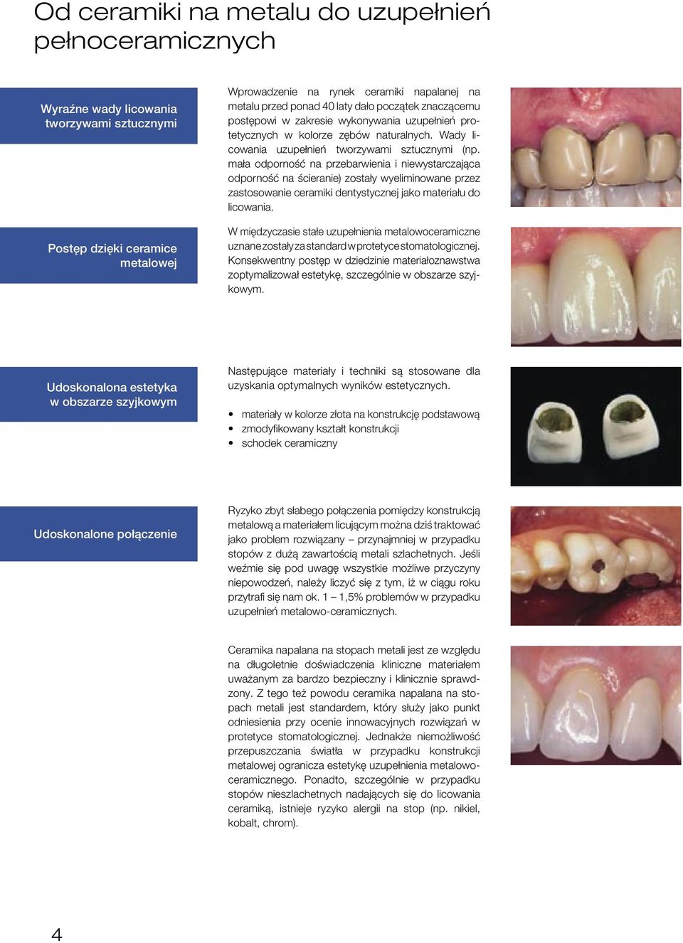 mała odporność na przebarwienia i niewystarczająca odporność na ścieranie) zostały wyeliminowane przez zastosowanie ceramiki dentystycznej jako materiału do licowania.