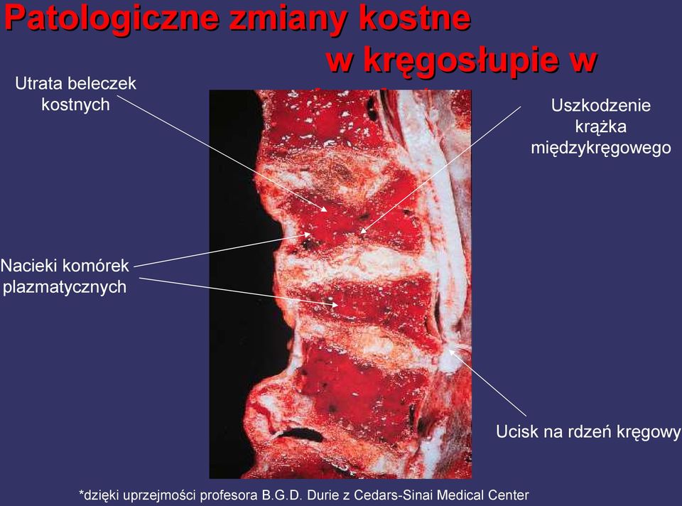 Nacieki komórek plazmatycznych Ucisk na rdzeń kręgowy