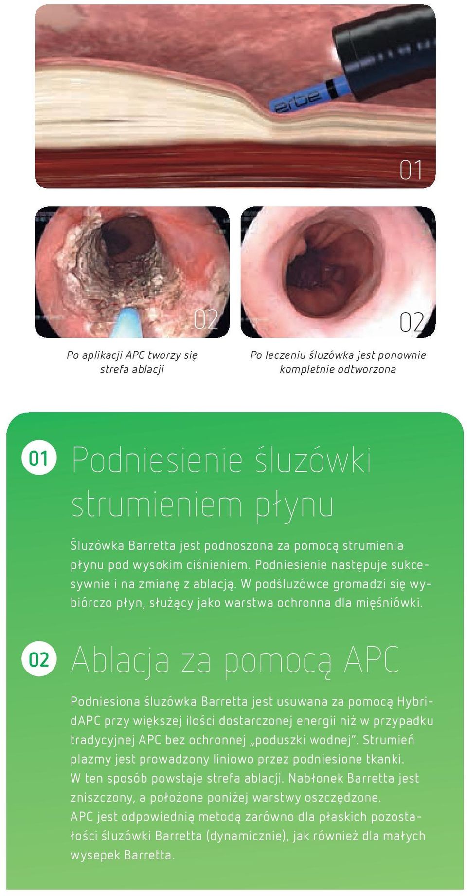 Ablacja za pomocą APC Podniesiona śluzówka Barretta jest usuwana za pomocą HybridAPC przy większej ilości dostarczonej energii niż w przypadku tradycyjnej APC bez ochronnej poduszki wodnej.