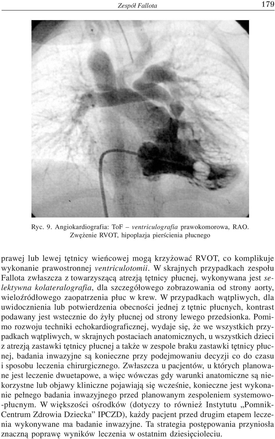 W skrajnych przypadkach zespo³u Fallota zw³aszcza z towarzysz¹c¹ atrezj¹ têtnicy p³ucnej, wykonywana jest selektywna kolateralografia, dla szczegó³owego zobrazowania od strony aorty, wieloÿród³owego