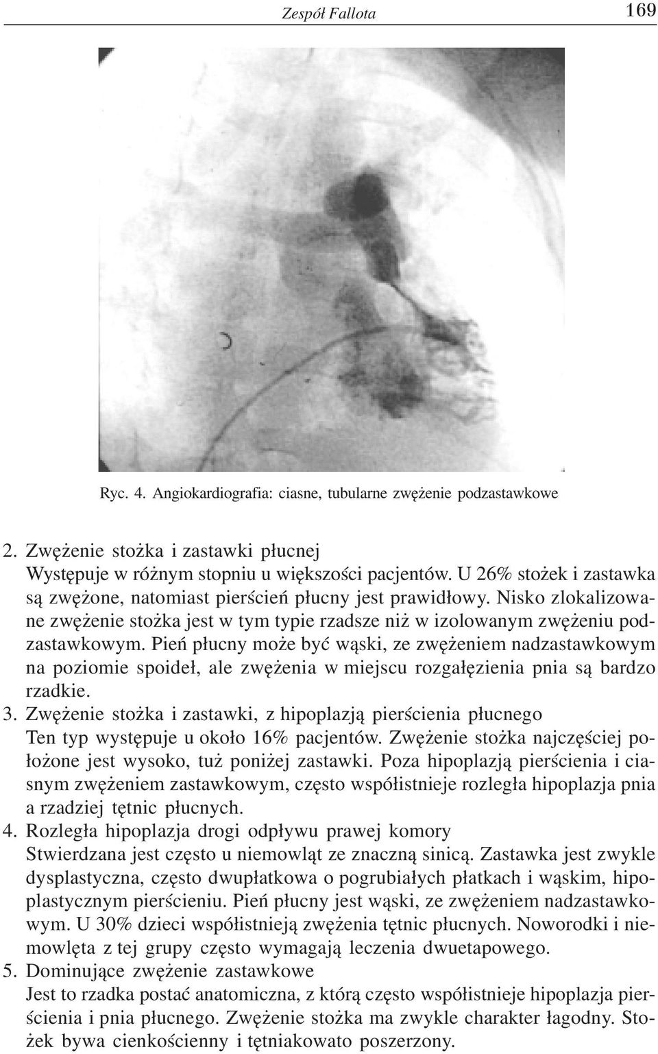 Pieñ p³ucny mo e byæ w¹ski, ze zwê eniem nadzastawkowym na poziomie spoide³, ale zwê enia w miejscu rozga³êzienia pnia s¹ bardzo rzadkie. 3.