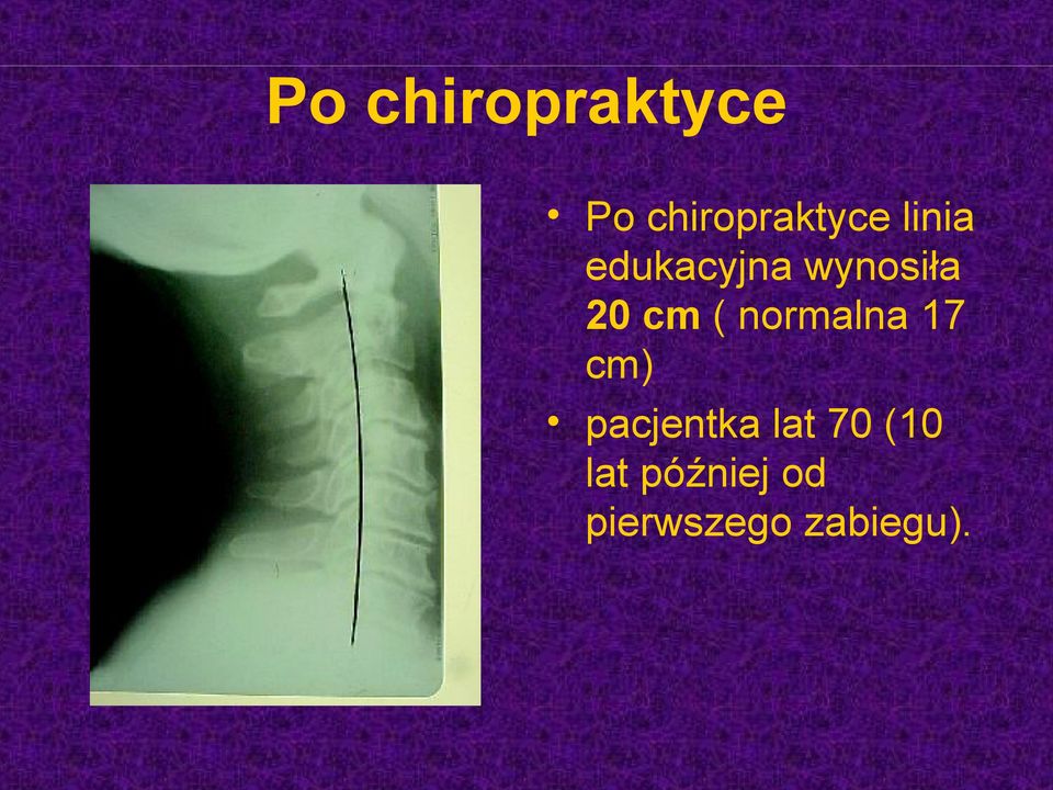 normalna 17 cm) pacjentka lat 70