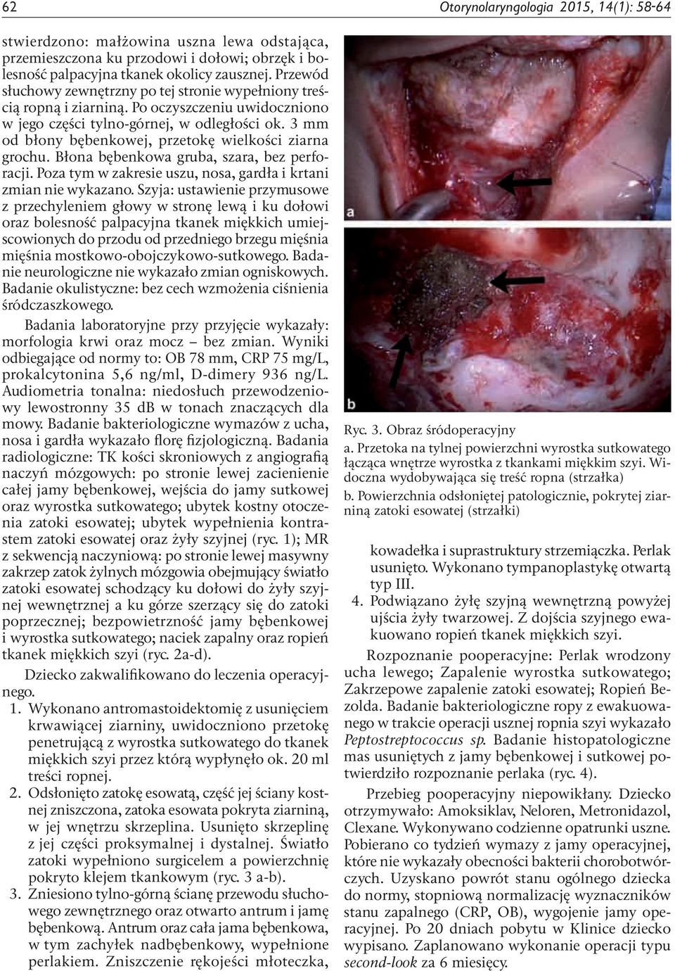 3 mm od błony bębenkowej, przetokę wielkości ziarna grochu. Błona bębenkowa gruba, szara, bez perforacji. Poza tym w zakresie uszu, nosa, gardła i krtani zmian nie wykazano.