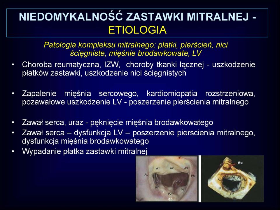 sercowego, kardiomiopatia rozstrzeniowa, pozawałowe uszkodzenie LV - poszerzenie pierścienia mitralnego Zawał serca, uraz - pęknięcie