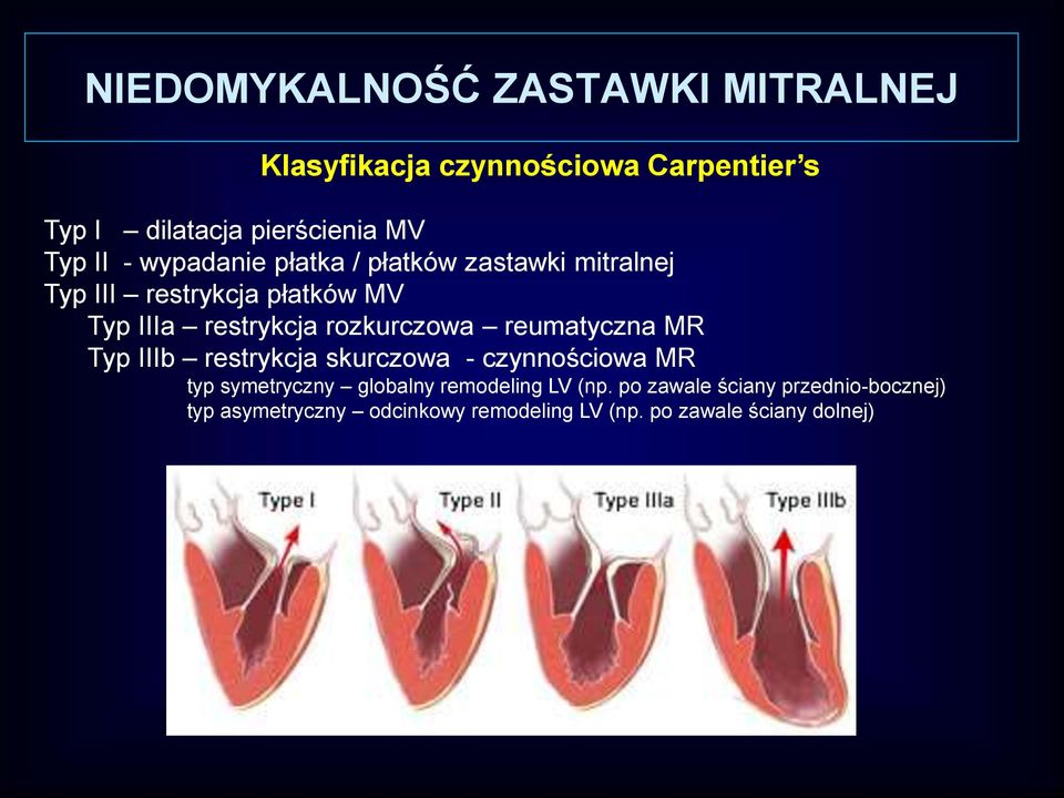 rozkurczowa reumatyczna MR Typ IIIb restrykcja skurczowa - czynnościowa MR typ symetryczny globalny