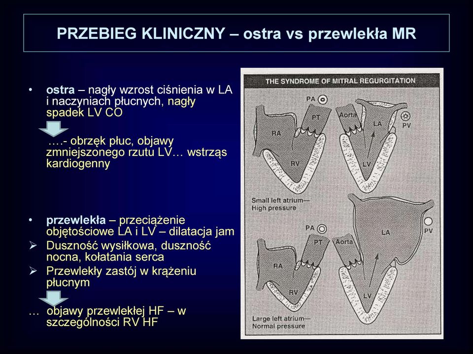 - obrzęk płuc, objawy zmniejszonego rzutu LV wstrząs kardiogenny przewlekła przeciążenie