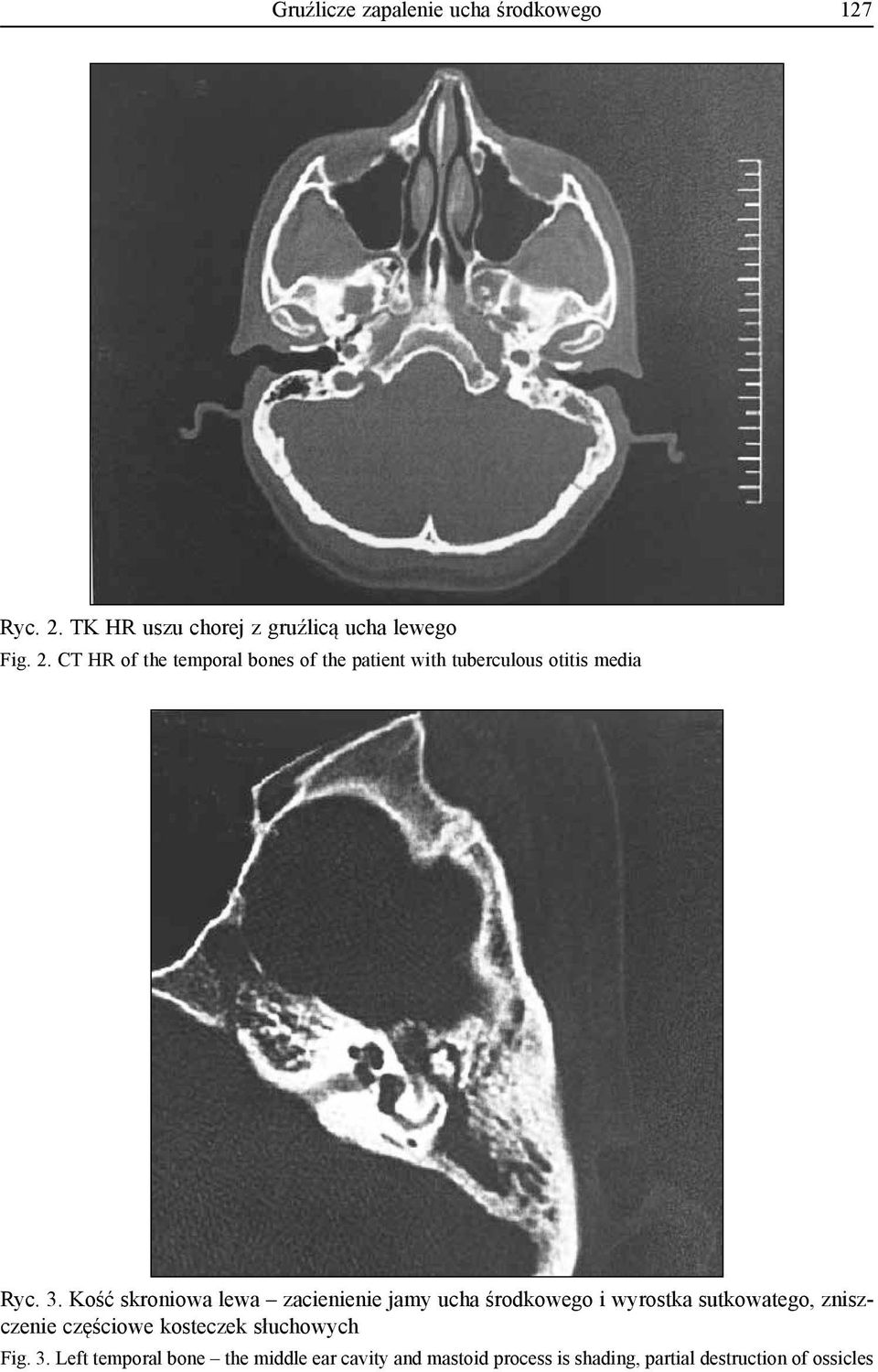 CT HR of the temporal bones of the patient with tuberculous otitis media Ryc. 3.