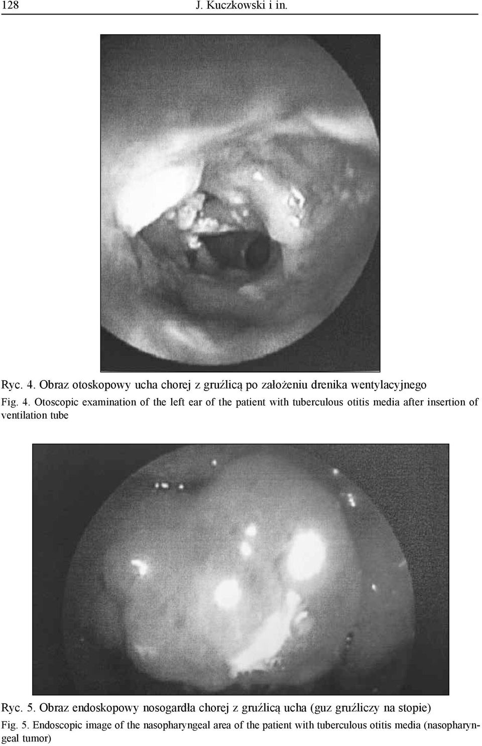 Otoscopic examination of the left ear of the patient with tuberculous otitis media after insertion of