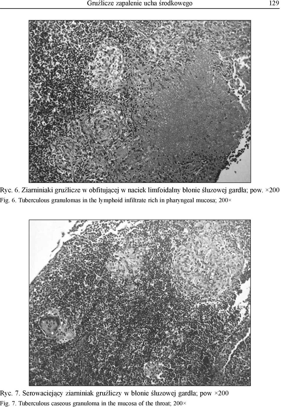 6. Tuberculous granulomas in the lymphoid infiltrate rich in pharyngeal mucosa; 200 Ryc. 7.