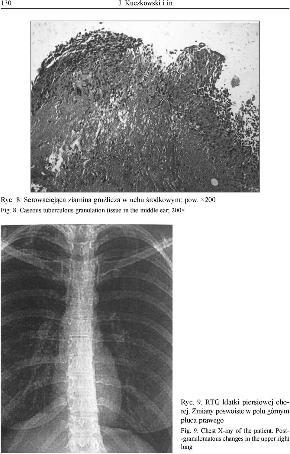 Caseous tuberculous granulation tissue in the middle ear; 200 Ryc. 9.