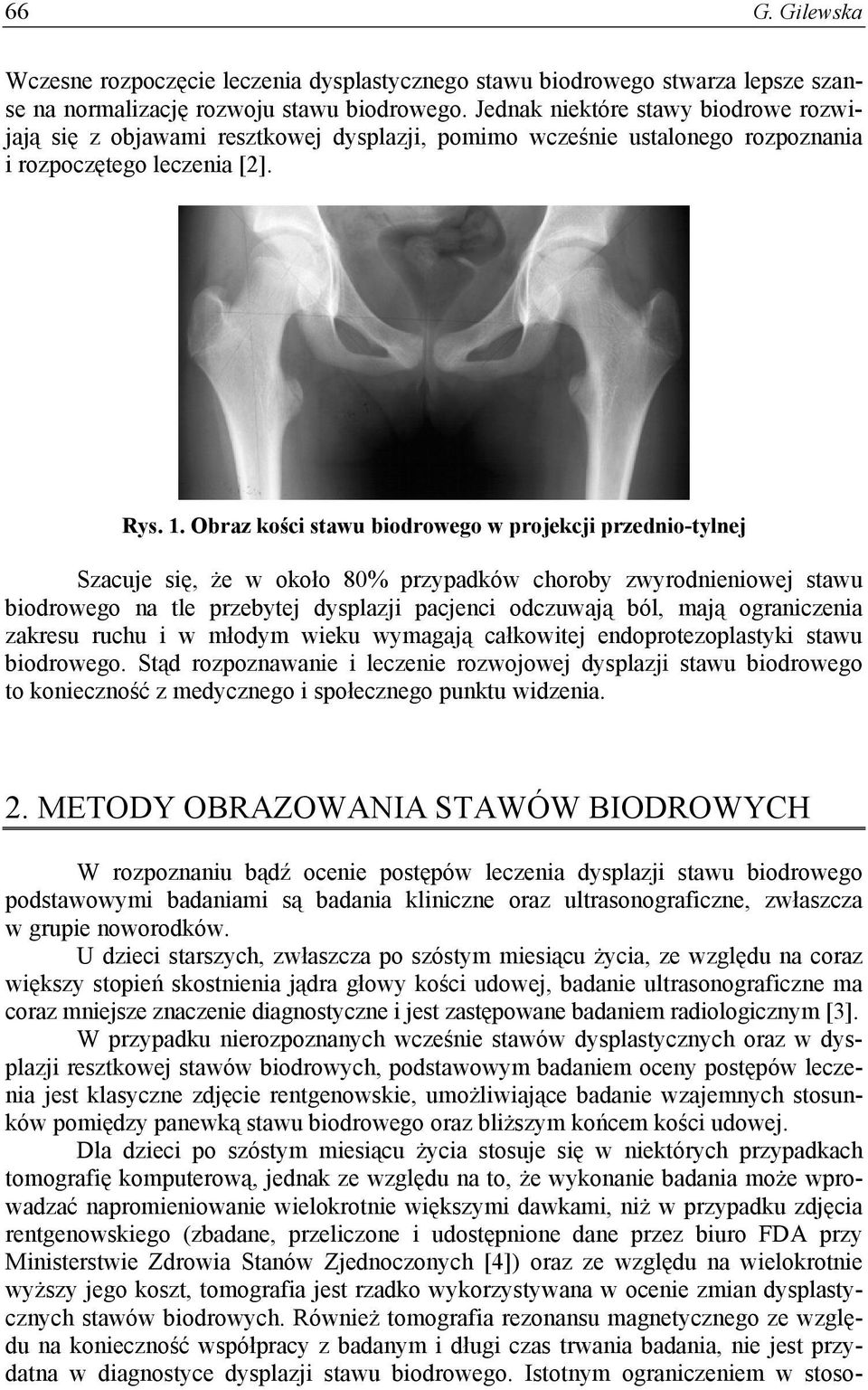 Obraz kości stawu biodrowego w projekcji przednio-tylnej Szacuje się, że w około 80% przypadków choroby zwyrodnieniowej stawu biodrowego na tle przebytej dysplazji pacjenci odczuwają ból, mają