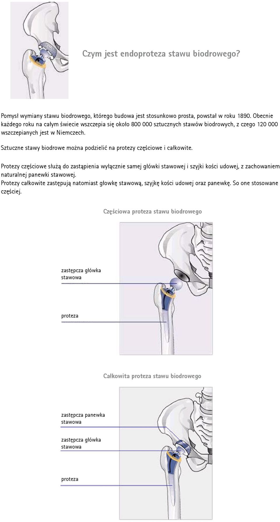 Sztuczne stawy biodrowe można podzielić na protezy częściowe i całkowite.