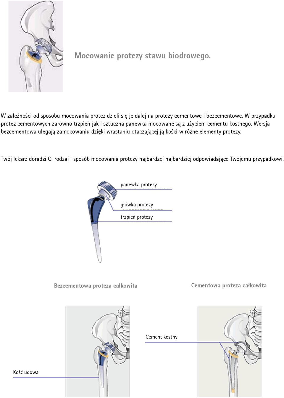 Wersja bezcementowa ulegają zamocowaniu dzięki wrastaniu otaczającej ją kości w różne elementy protezy.
