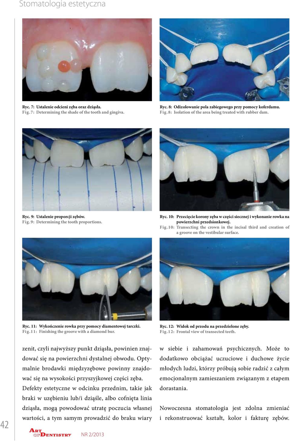 Transecting the crown in the incisal third and creation of a groove on the vestibular surface. Ryc. 11: Wykończenie rowka przy pomocy diamentowej tarczki. Fig.