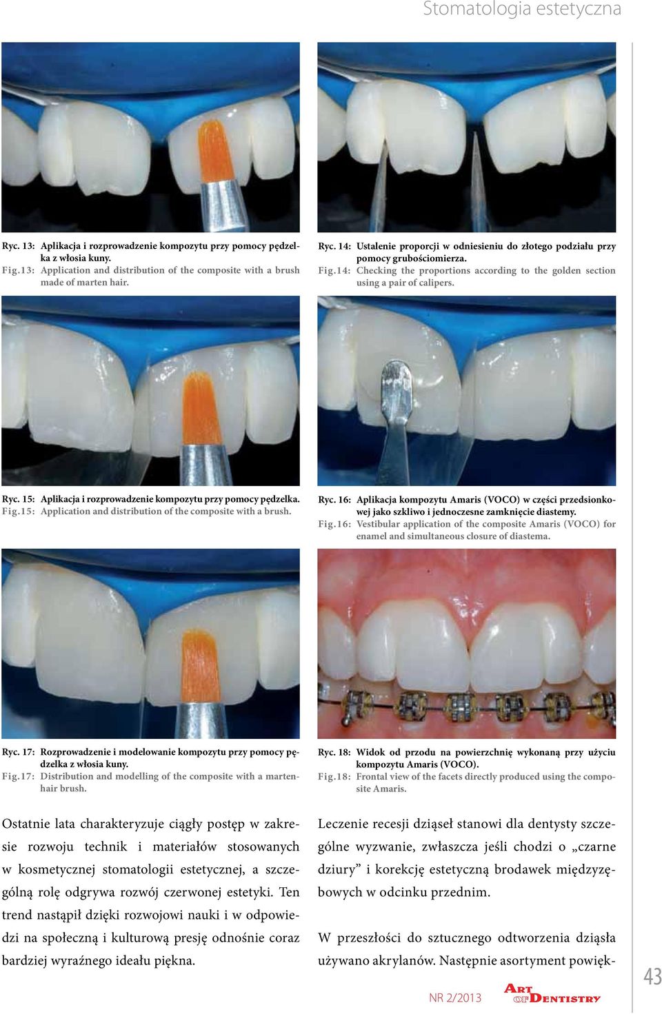 15: Aplikacja i rozprowadzenie kompozytu przy pomocy pędzelka. Fig.15: Application and distribution of the composite with a brush. Ryc. 16: Fig.