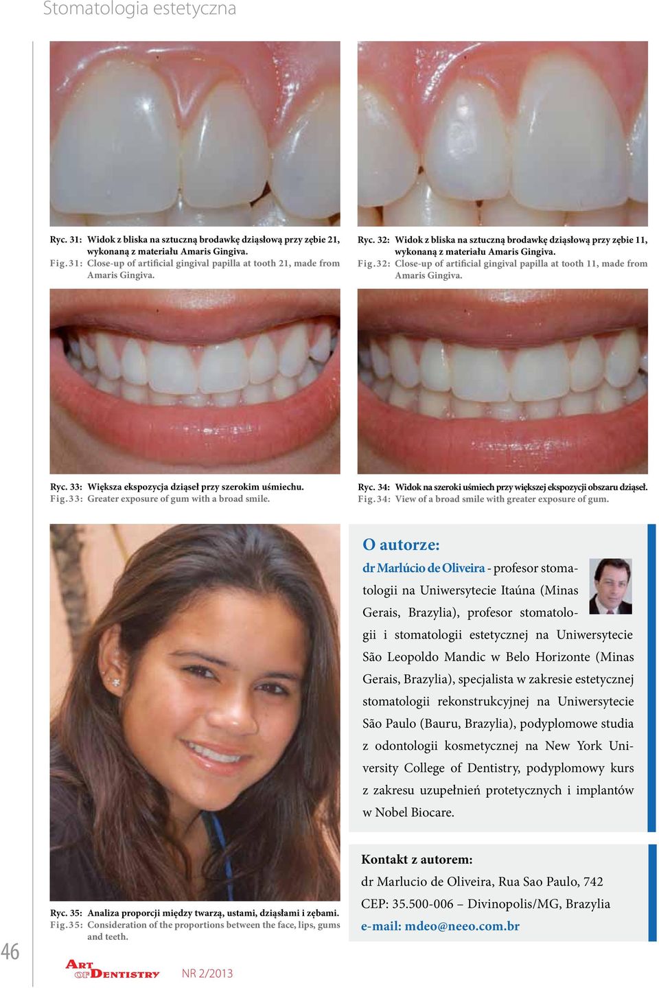 33: Większa ekspozycja dziąseł przy szerokim uśmiechu. Fig.33: Greater exposure of gum with a broad smile. Ryc. 34: Widok na szeroki uśmiech przy większej ekspozycji obszaru dziąseł. Fig.34: View of a broad smile with greater exposure of gum.