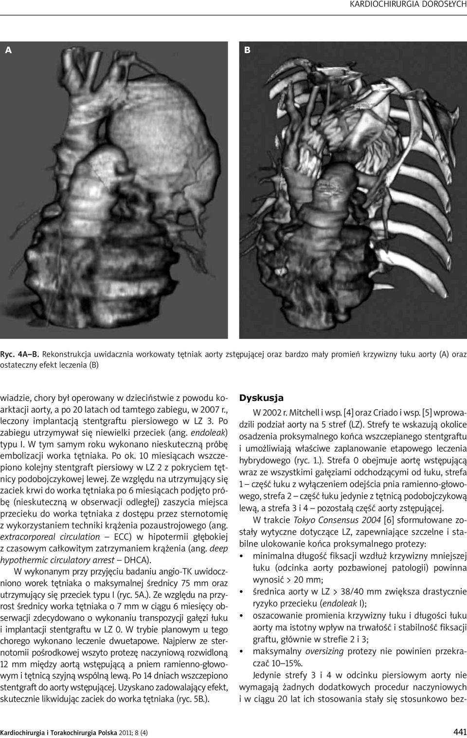 koarktacji aorty, a po 20 latach od tamtego zabiegu, w 2007 r., leczony implantacją stentgraftu piersiowego w LZ 3. Po zabiegu utrzymywał się niewielki przeciek (ang. endoleak) typu I.